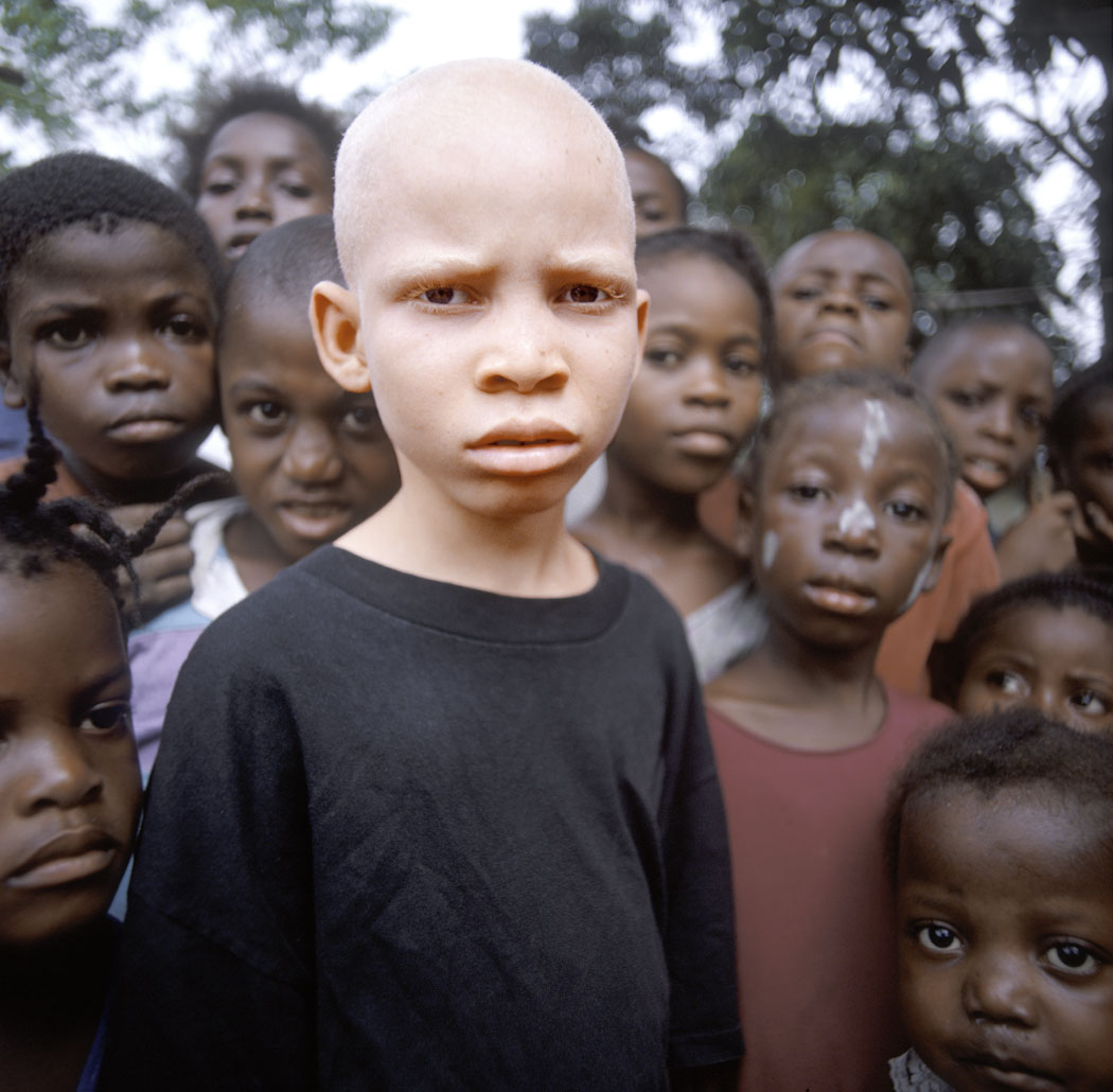 Африкалык альбинос.